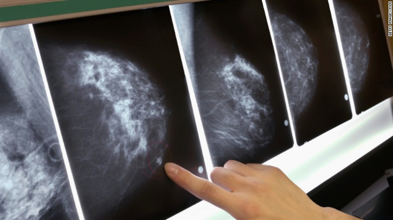 Body fat levels linked to breast cancer risk in post-menopausal women