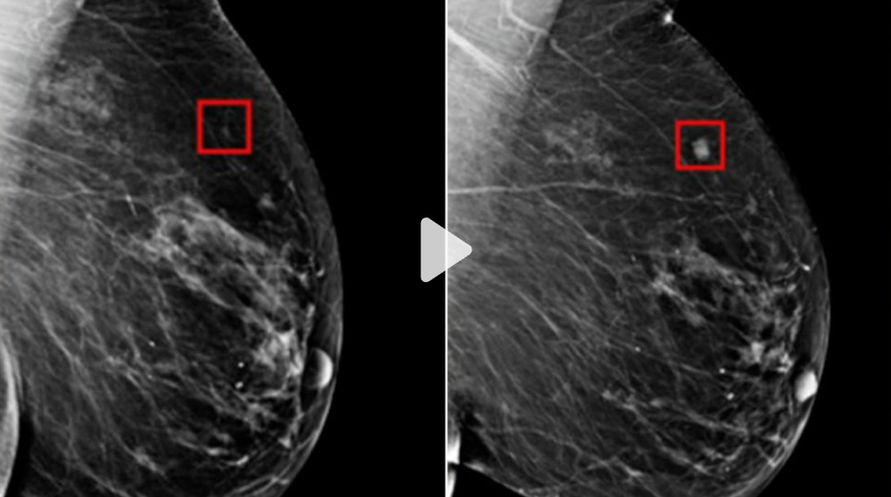 Drug cuts risk of breast cancer recurrence for some early-stage patients, trial shows